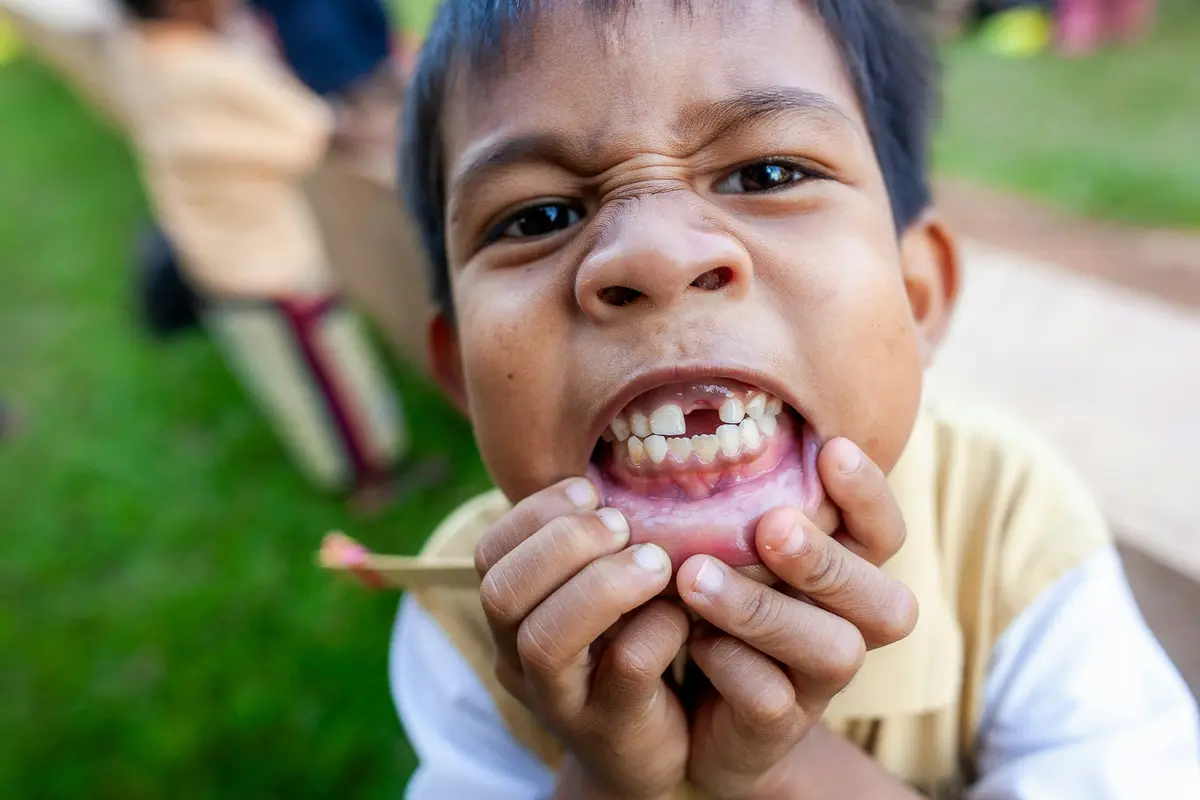 A young boy pulling his lip down to show a missing tooth