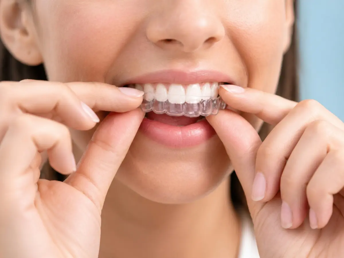 A person pressing a clear aligner onto their teeth