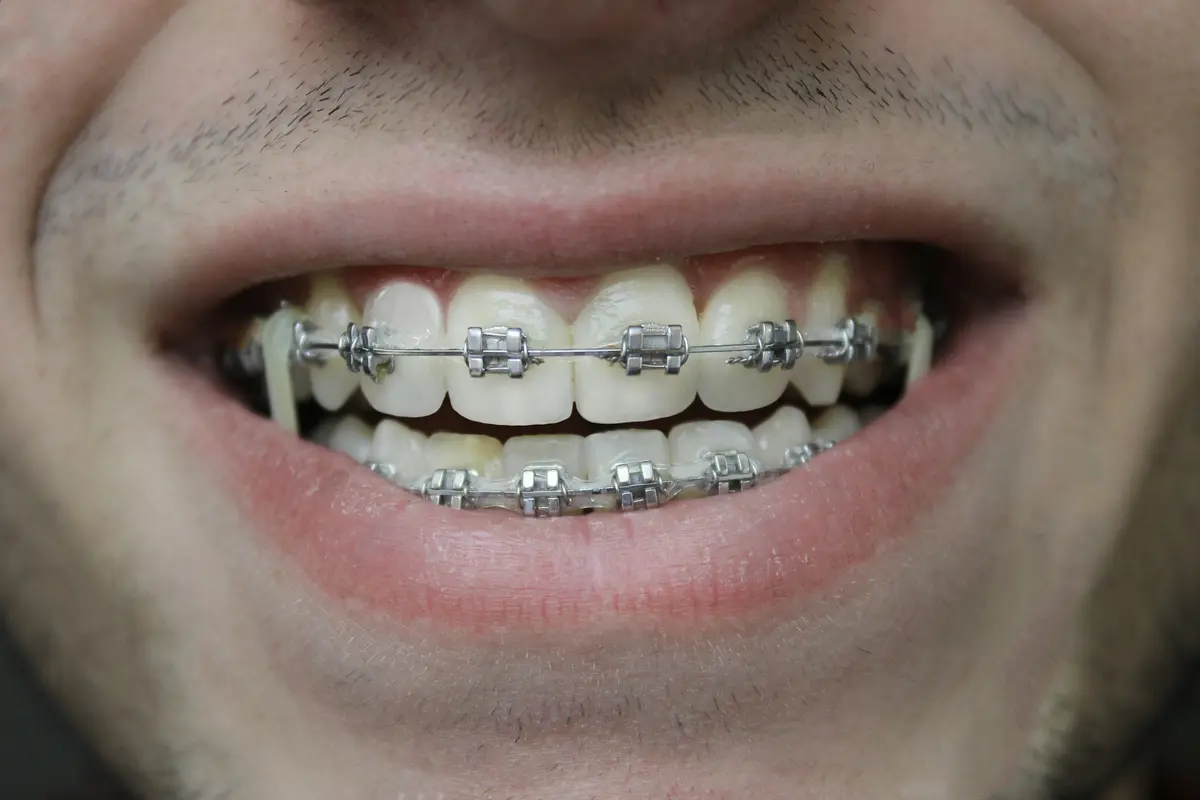 A smile with metal braces