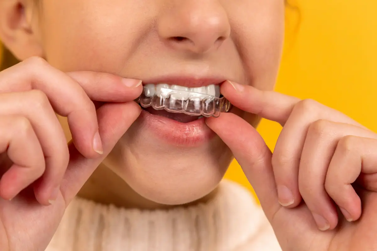A woman putting a clear aligner on her teeth